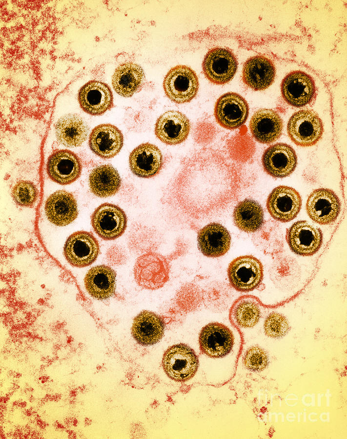 Herpes Photograph by Science Source