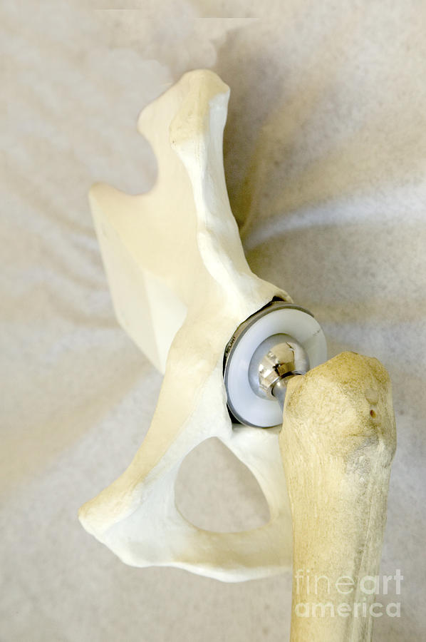 Hip Replacement Photograph by Inga Spence