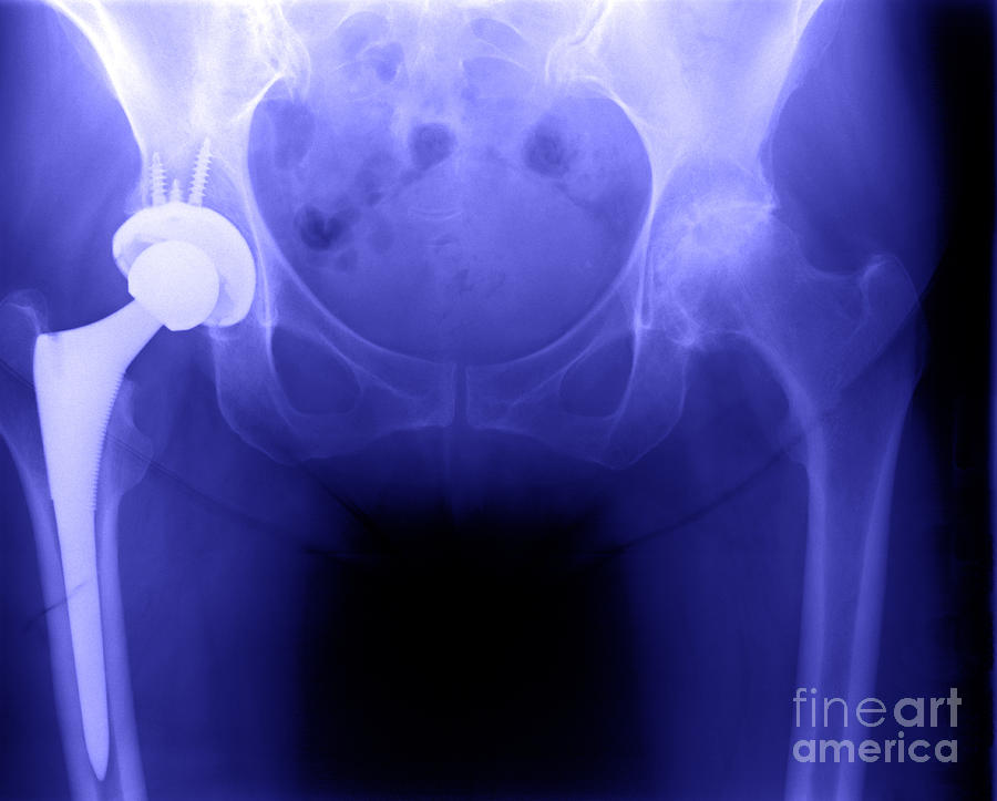 Surgical Photograph - Hip Replacement by Ted Kinsman