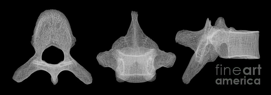 Human Vertebra T5, X-ray Photograph by Ted Kinsman