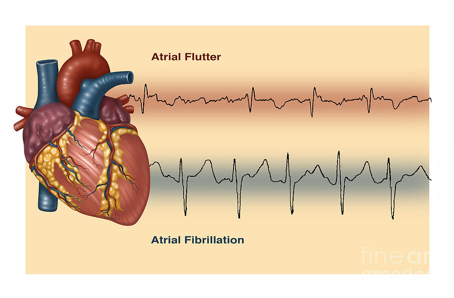 Illustration Of Irregular Heartbeats Photograph by Gwen Shockey