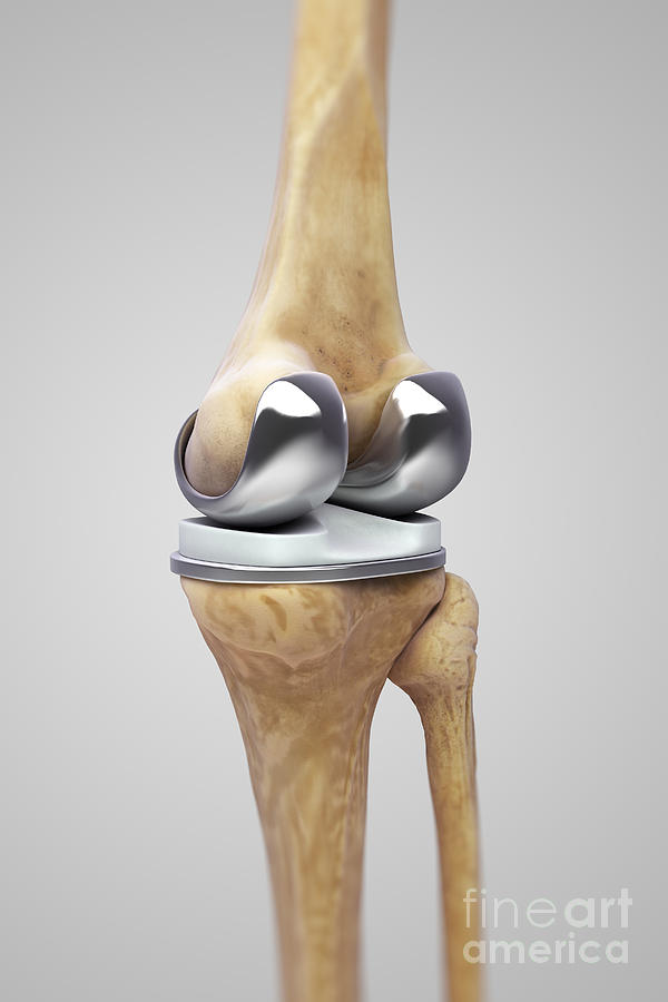 Knee Replacement Photograph by Science Picture Co