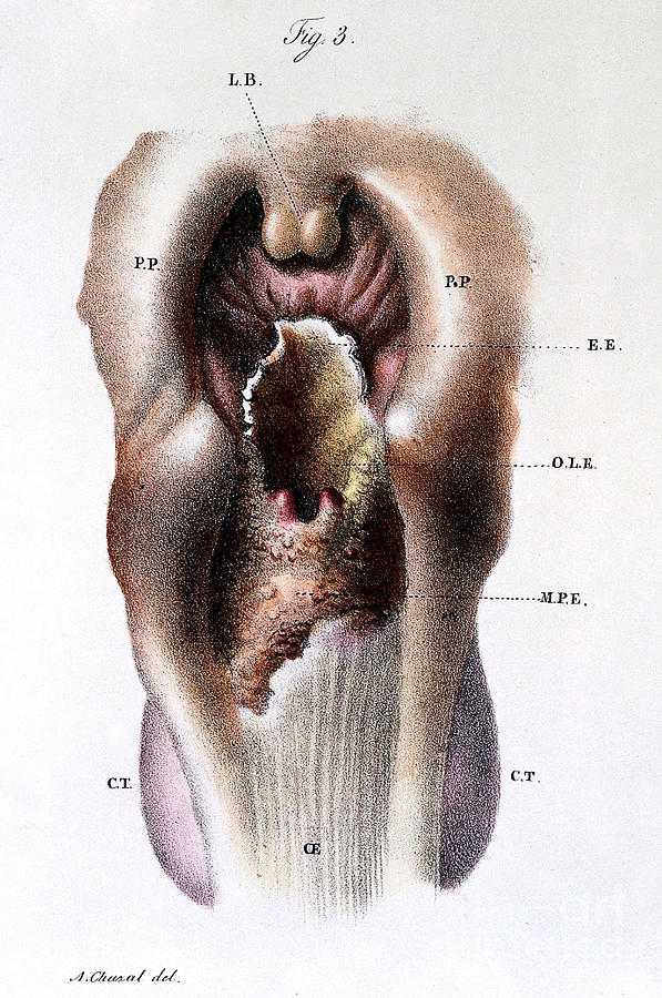 Larynx, Pathology, Illustration, 19th Photograph by Wellcome Images