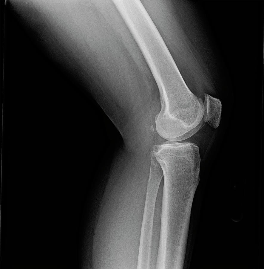 Left knee joint x-ray of mature female with osteoarthritis Photograph by Karen Foley