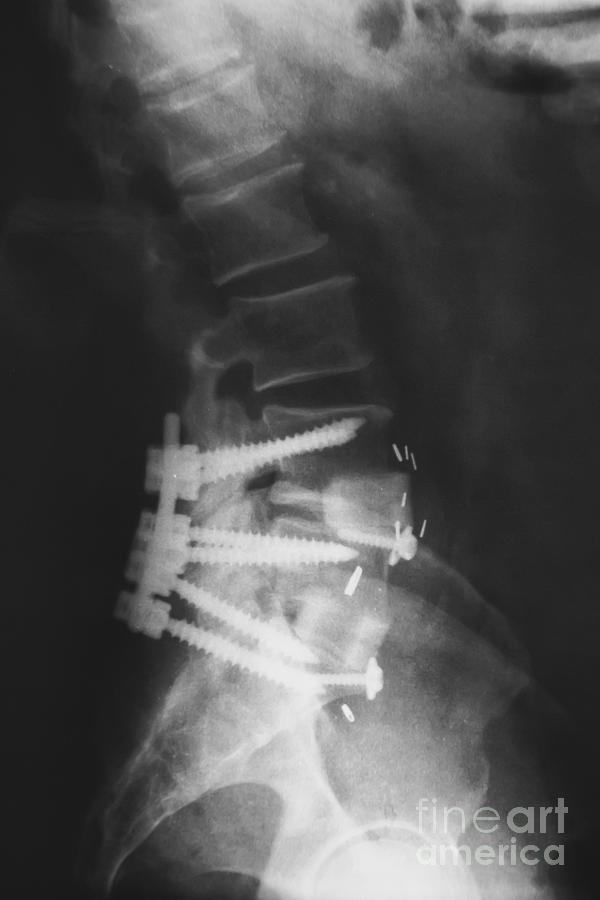 Lumbar Spinal Fusion Photograph by Olga Hamilton