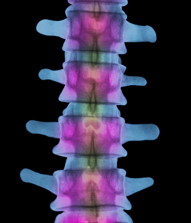 Lumbar Spine, X-ray Photograph by 