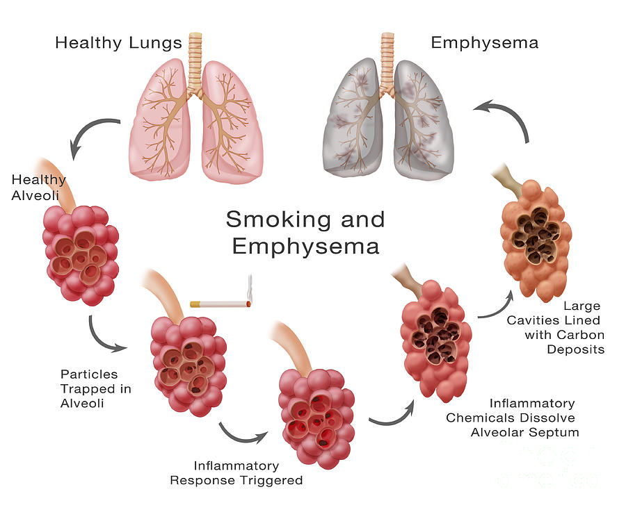 Lung Damage Leading To Emphysema Photograph by Monica Schroeder