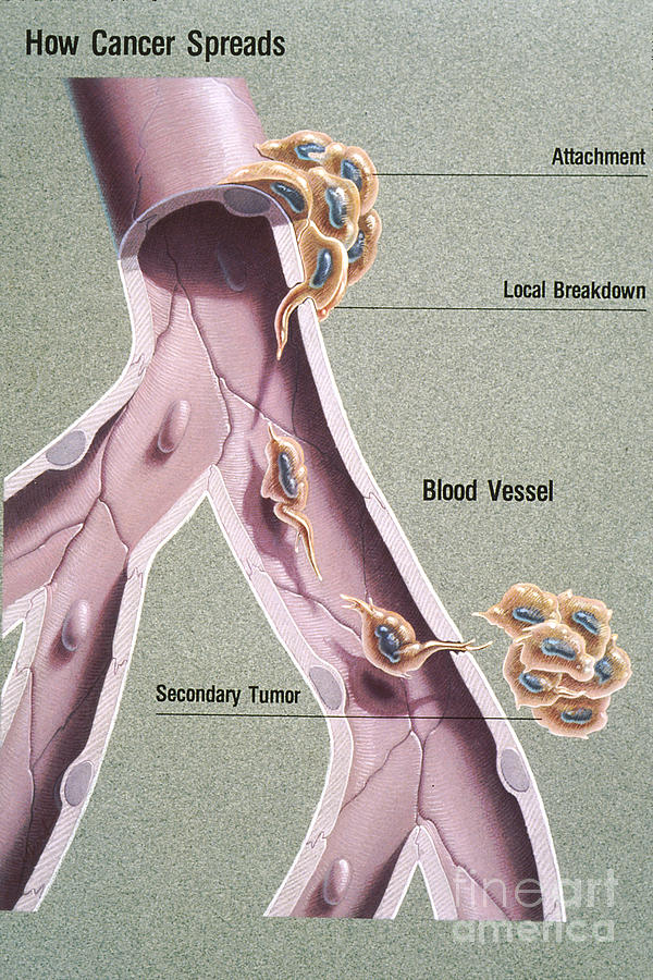 Metastasis, How Vancer Spreads Photograph by Science Source