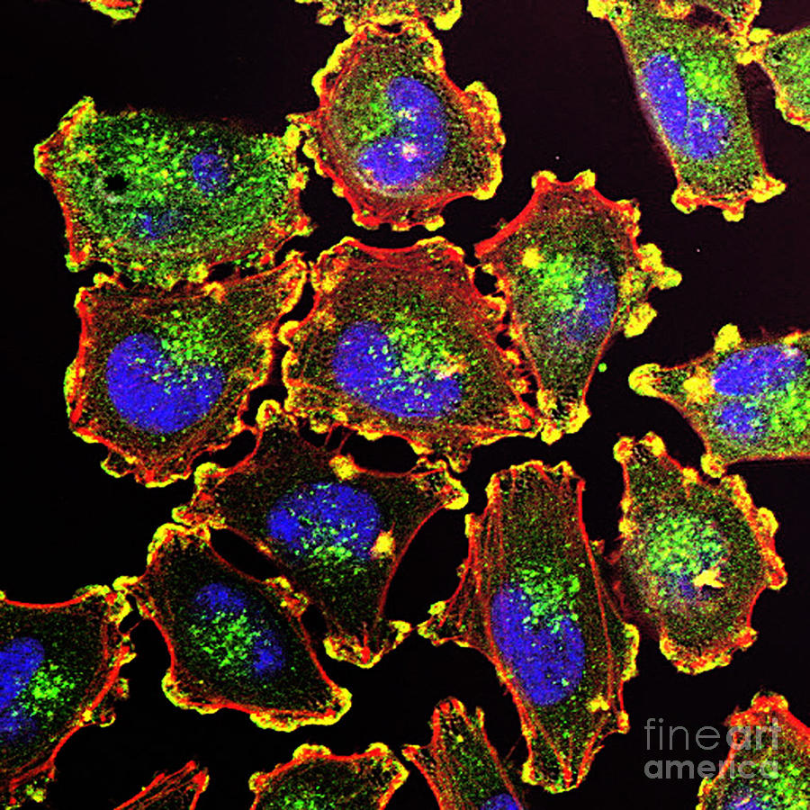 Metastatic Melanoma Cells, Fm Photograph by Science Source