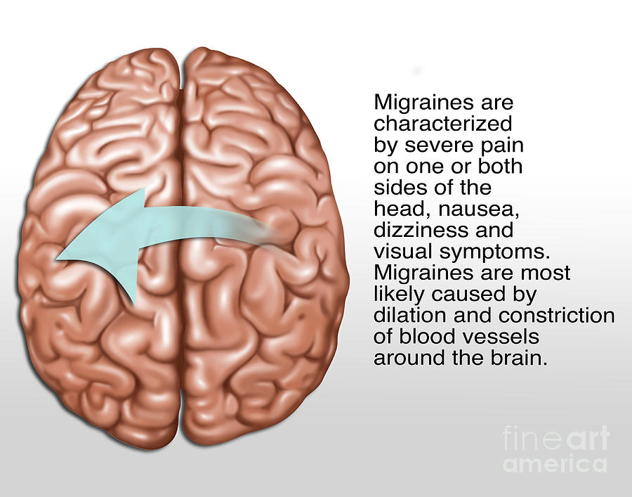 Migraine, Illustration Photograph by Gwen Shockey