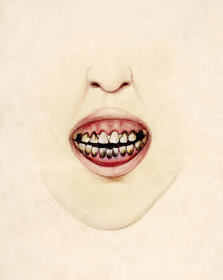 Mouth Of Gouty Patient, Illustration Photograph by Wellcome Images