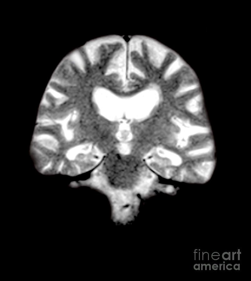 Magnetic Resonance Imaging Photograph - Mri Of Brain With Alzheimers Disease by Medical Body Scans