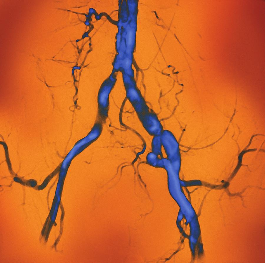 Iliac Photograph - Narrowed Abdominal Arteries, Angiogram by Miriam Maslo