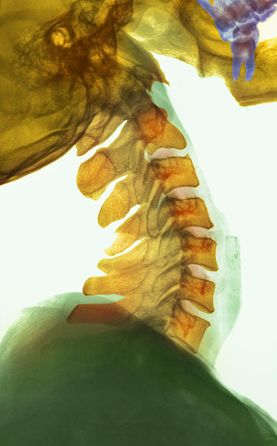 Neck Vertebrae Flexed, X-ray Photograph by 