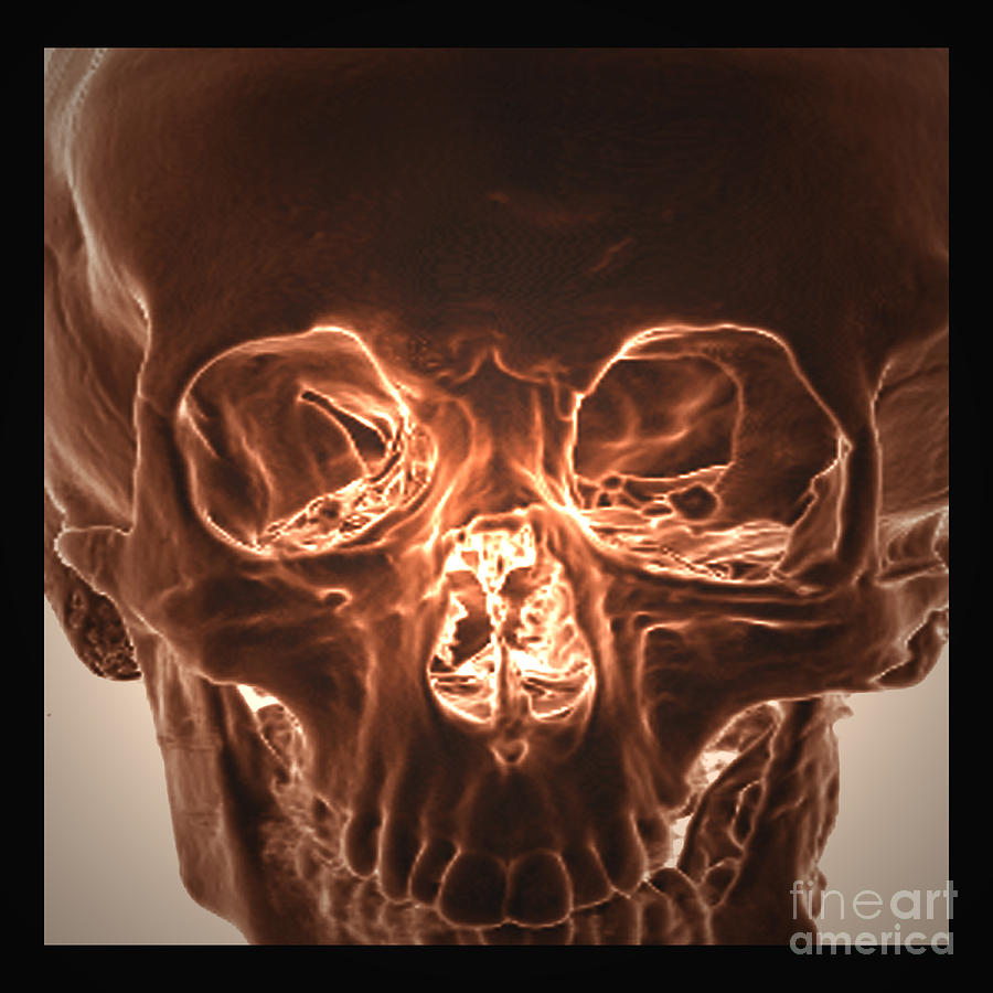 Neurofibromatosis Type I, 3d Ct Scan Photograph by Living Art Enterprises