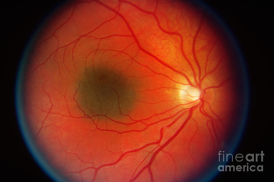 Nevus In The Retina Photograph by Science Source