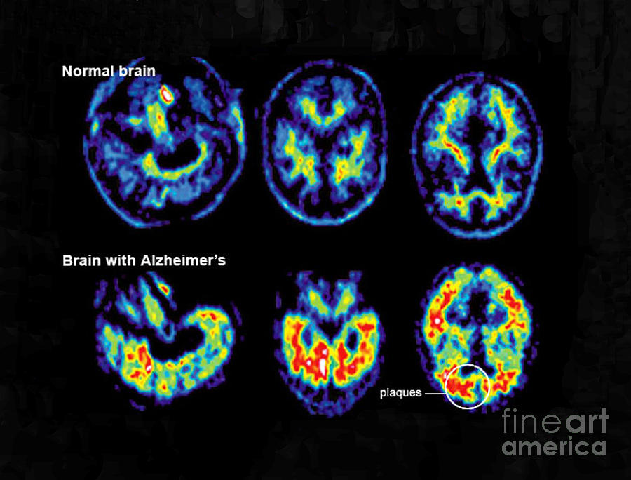 Normal And Alzheimer Brains, Pet Scans Photograph by Science Source