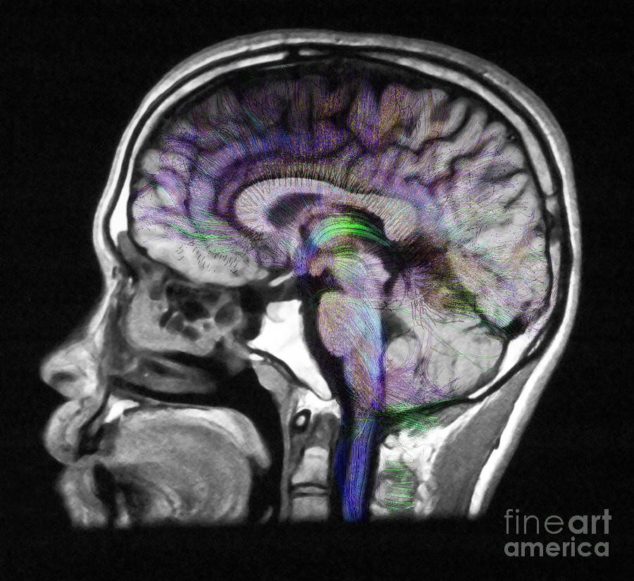 Normal Brain, Fiber Tractography And Mri Photograph by Scott Camazine
