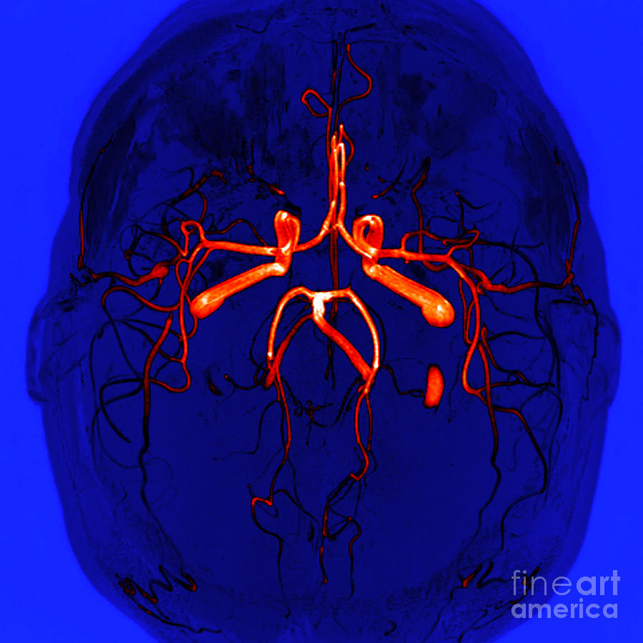 Normal Brain, Mra Photograph by Living Art Enterprises