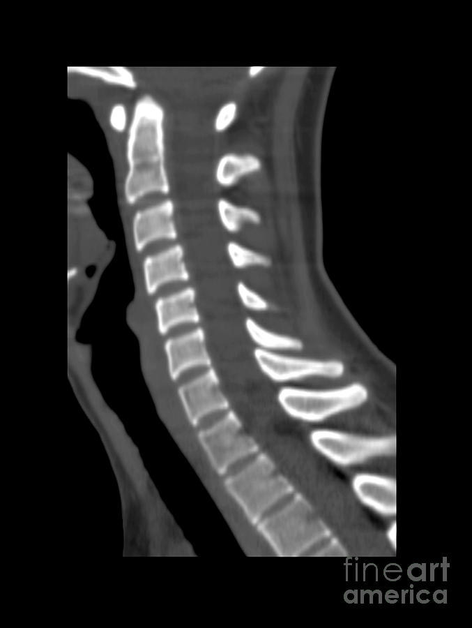 Normal Cervical Spine Photograph by Medical Body Scans