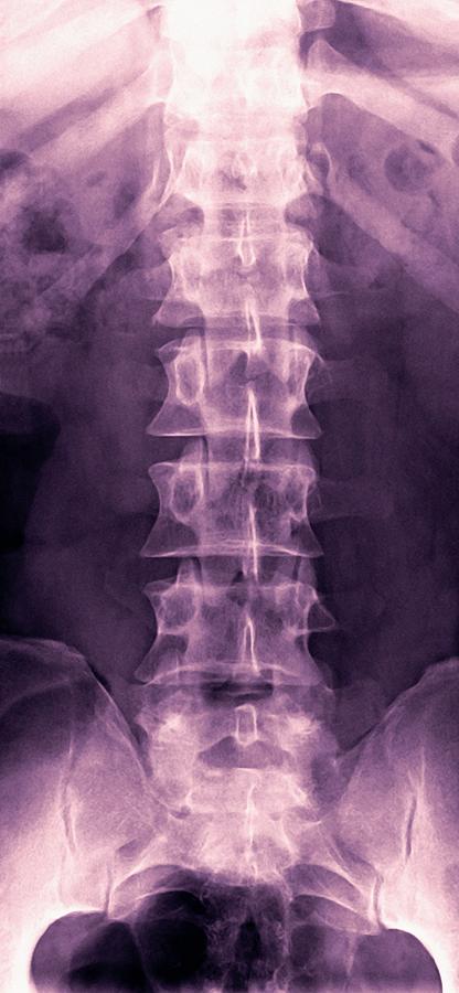 lumbar vertebrae x ray