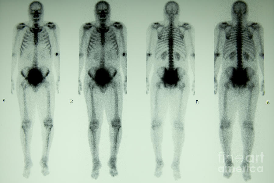 Nuclear Bone Scan Photograph by Inga Spence