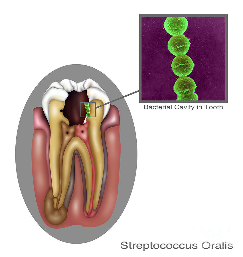 Oral Infection Of Streptococcus Oralis Photograph by Gwen Shockey