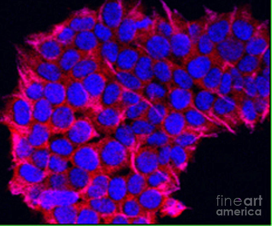 Pancreatic Cancer, Confocal Microscopy Photograph by Science Source