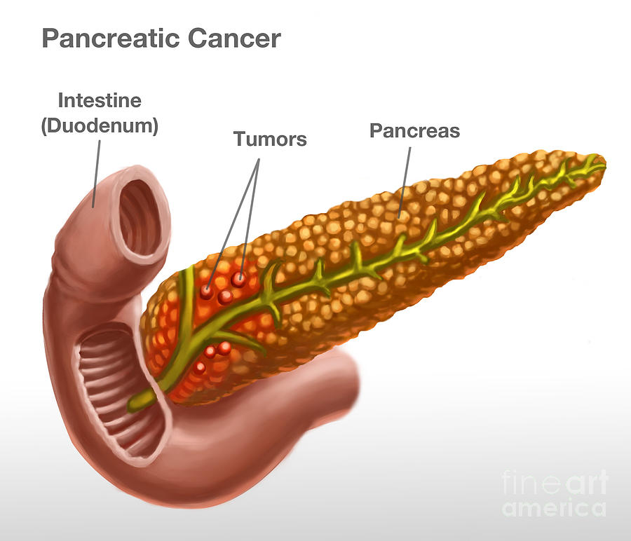 Pancreatic Cancer, Illustration Photograph by Spencer Sutton