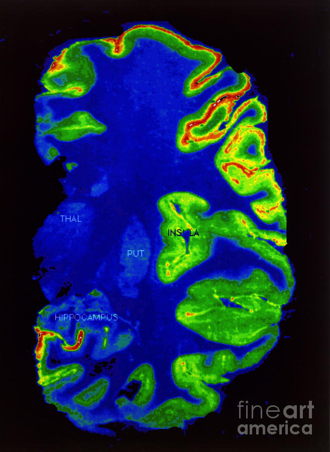 Diagnostic Photograph - Pet Scan, Healthy Brain by Science Source