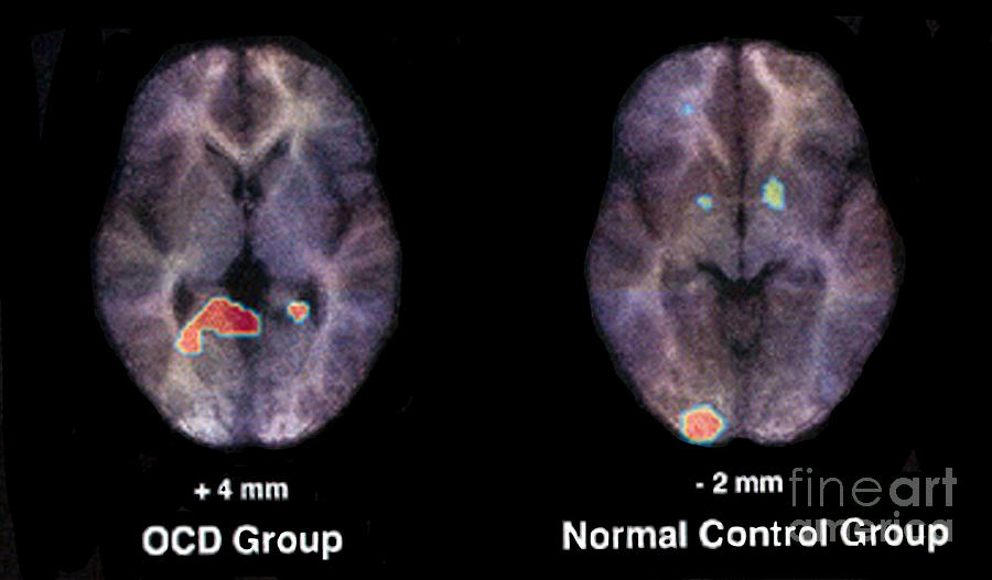 Pet Scan, Normal And Ocd Brain Photograph by Science Source