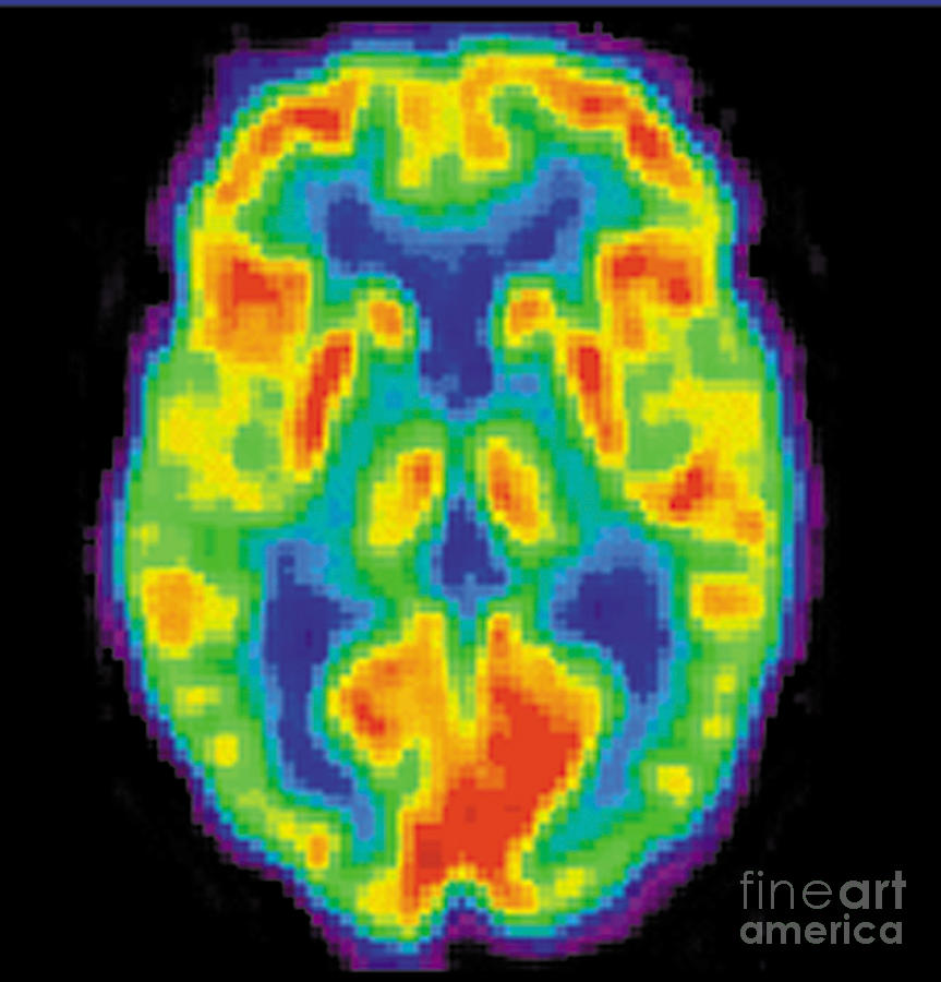 Pet Scan Of 20-year-old Brain Photograph by Science Source