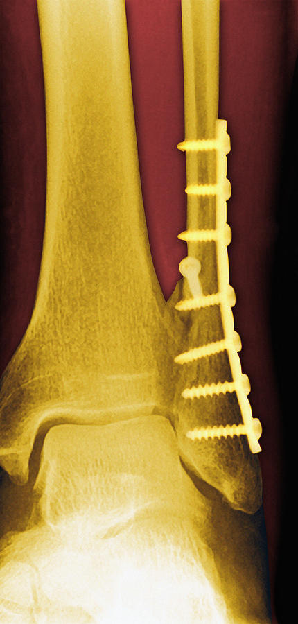 Screw Photograph - Pinned Ankle Fracture, Coloured X-ray by Miriam Maslo