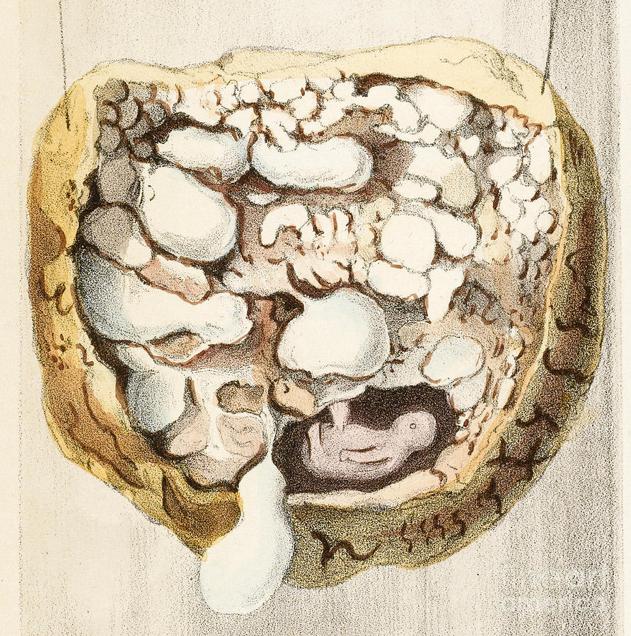 Placenta With Tumors, Illustration, 1836 Photograph by Wellcome Images