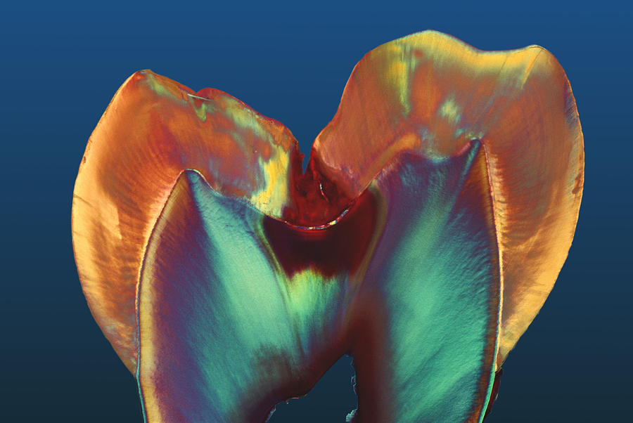Enamel Photograph - Polarised Lm Of A Molar Tooth Showing Decay by Volker Steger