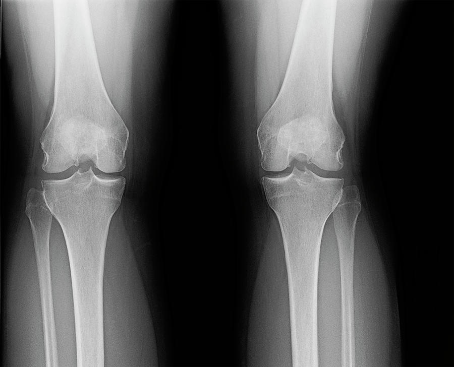 Rear knee joint x-ray of mature female with osteoarthritis Photograph by Karen Foley