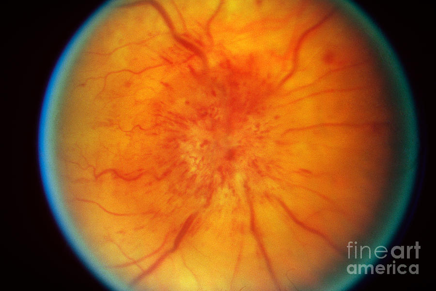 Retinal Papilledema Photograph by Science Source