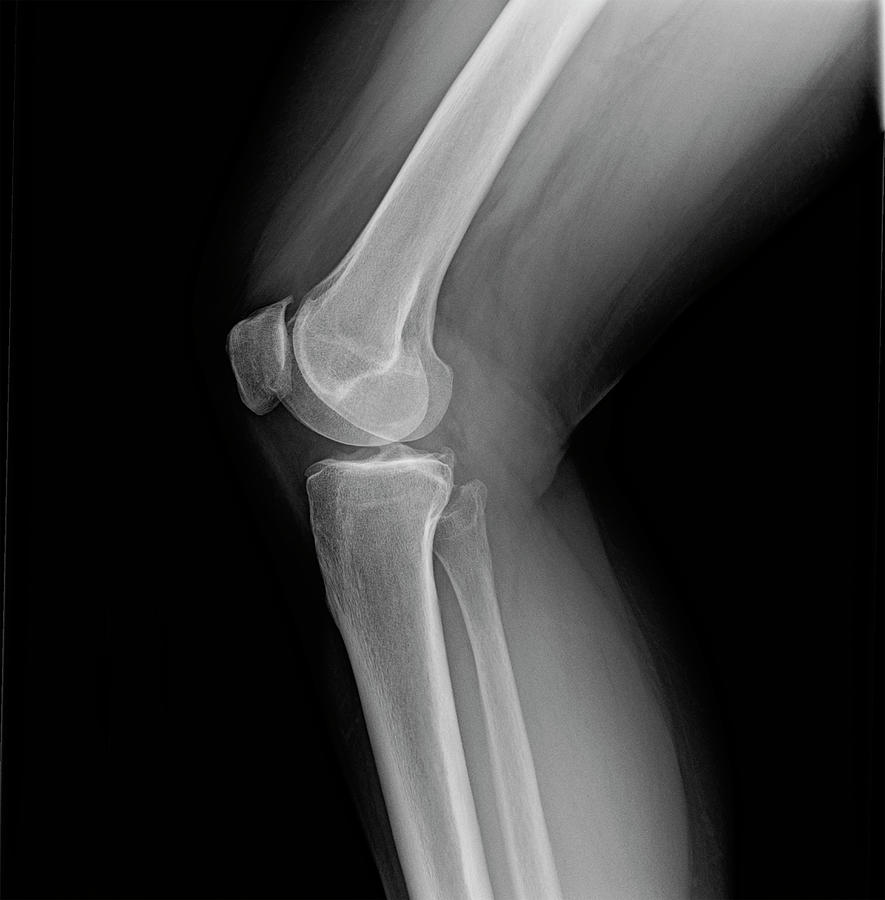 Right knee joint x-ray of mature female with osteoarthritis Photograph by Karen Foley
