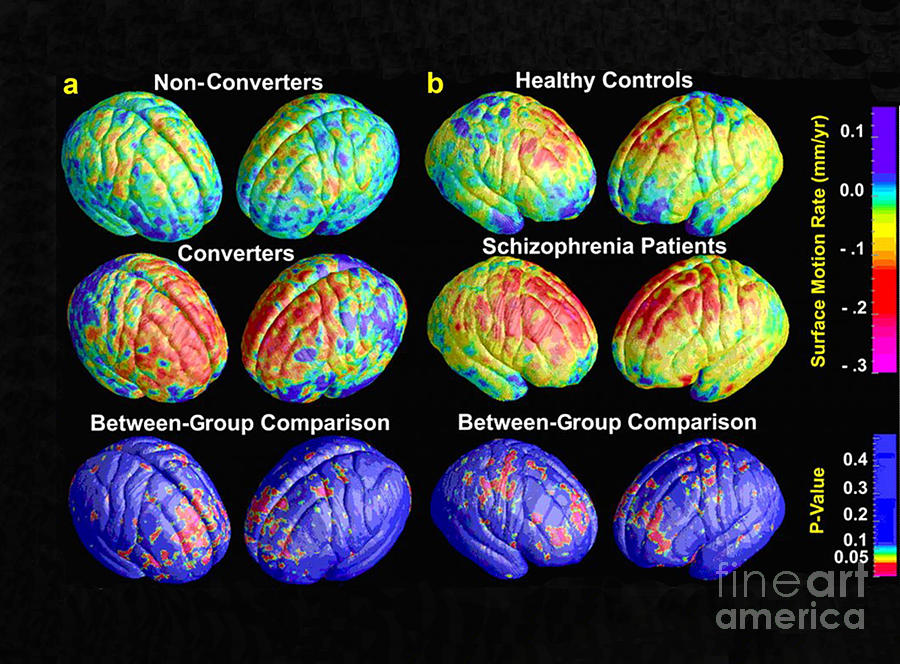 Schizophrenia, 3d Mri Scans Photograph by Science Source