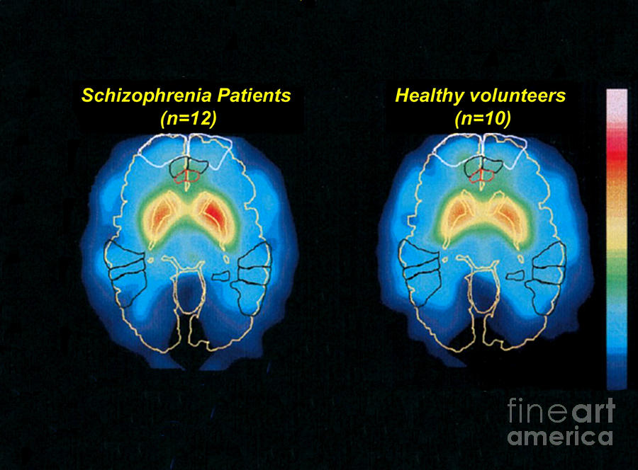 Schizophrenia And Normal Brain, Pet Photograph by Science Source