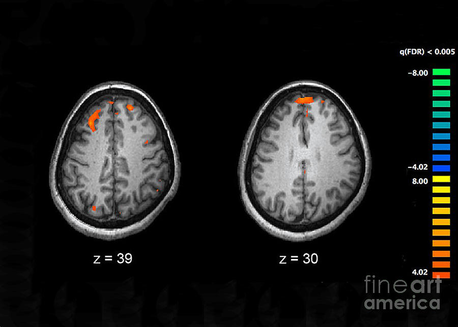 Schizophrenia, Mri Scans Photograph by Science Source