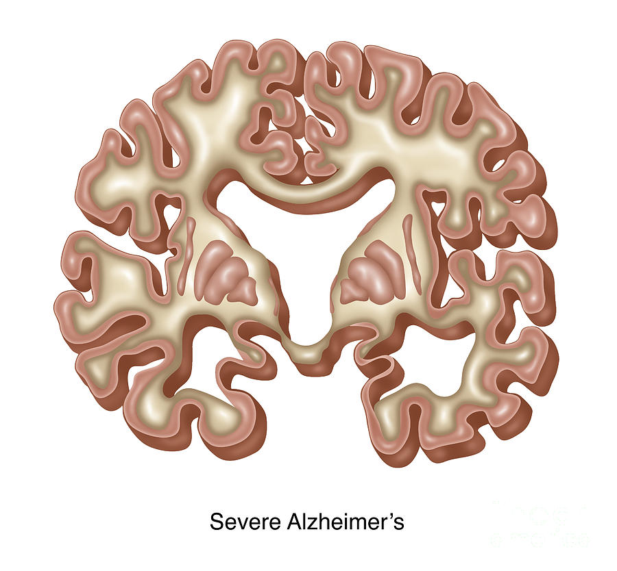 Severe Alzheimers, Illustration Photograph by Gwen Shockey