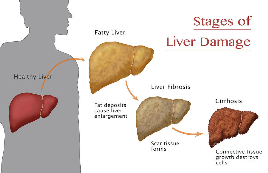 Liver Diseases Stages Of Liver Damage Healthy Fatty And Cirrhosis | My ...