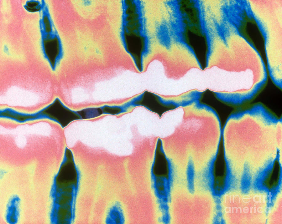 Teeth With Fillings, X-ray Photograph by Scimat