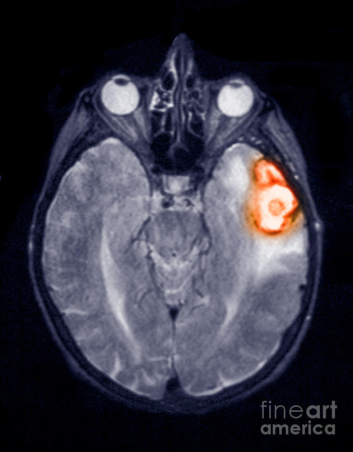 Temporoparietal Brain Hemorrhage, Mri Photograph By Scott Camazine