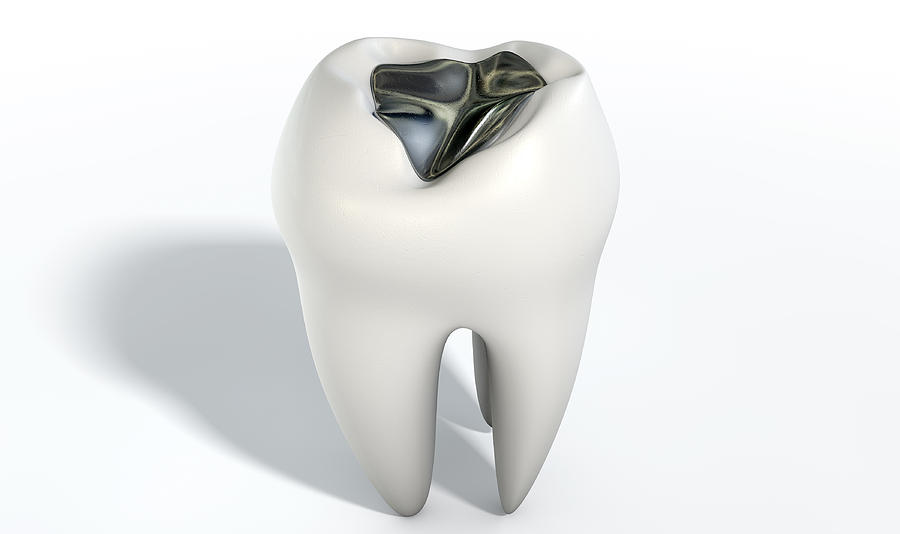 Teeth Digital Art - Tooth With Lead Filling by Allan Swart