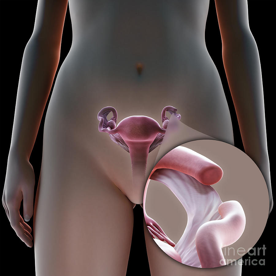 Tubal Ligation Coagulation Photograph by Science Picture Co