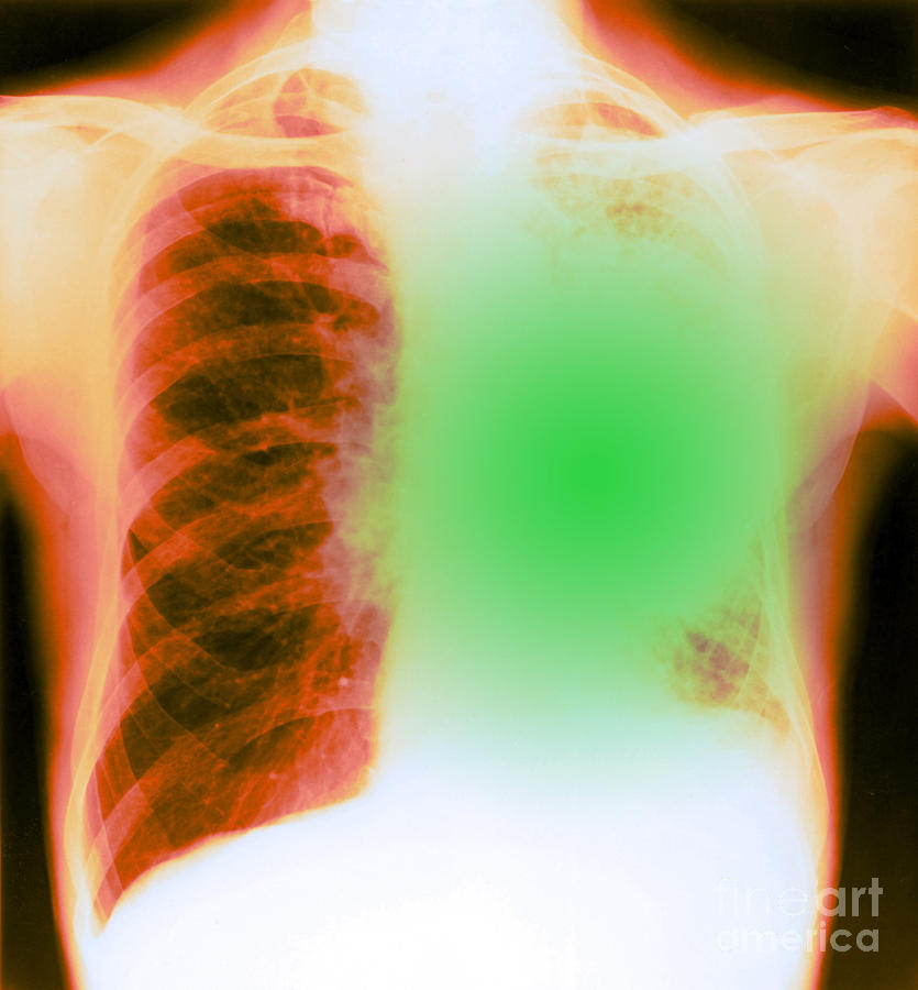 X-ray Of Bronchial Carcinoma Photograph by Biophoto Associates