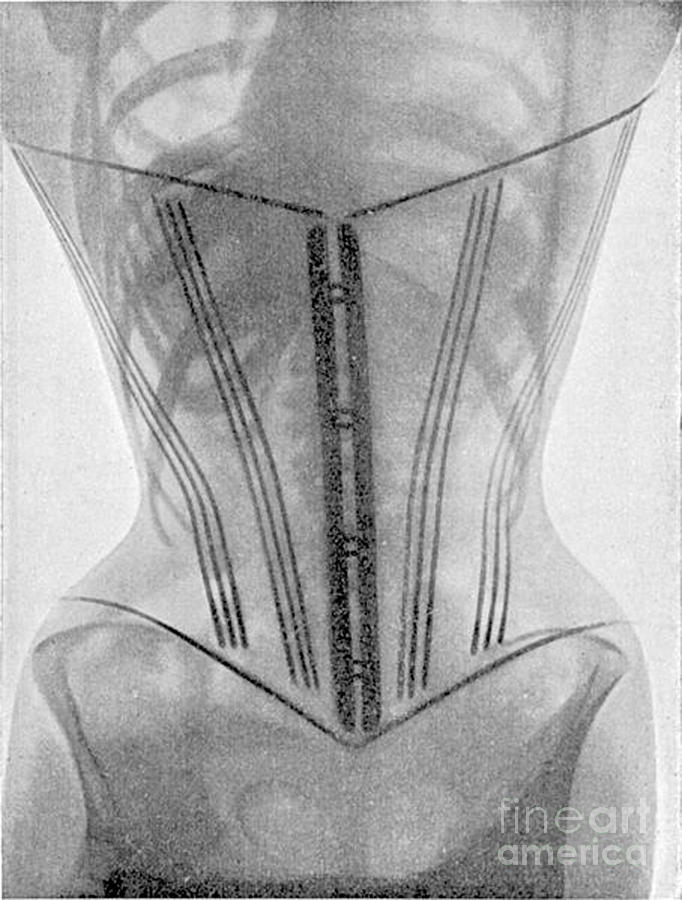X-ray Of Woman Wearing Corset, 1908 Photograph by Science Source