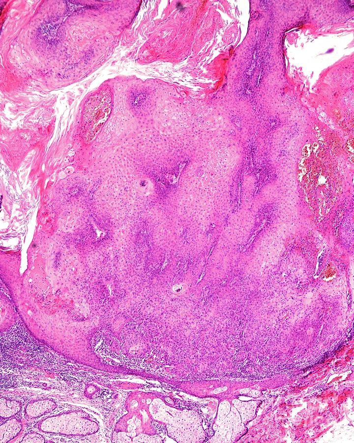 Actinic Keratosis Photograph By Jose Calvo   Science Photo Library 